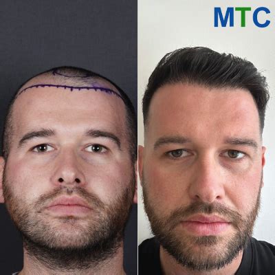 Hair Transplant Turkey Reviews .